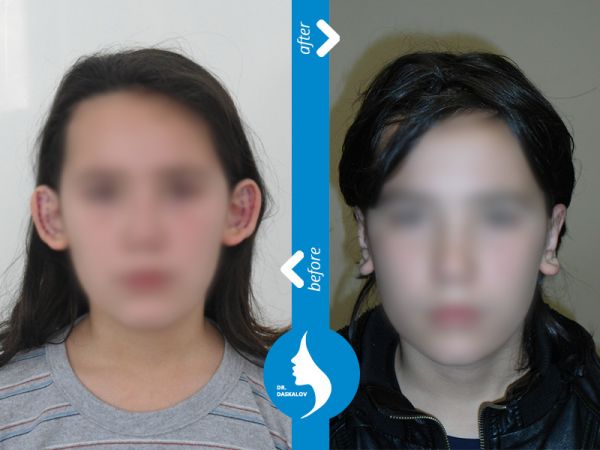 Корекција на уши — споредба 1: пред лево, потоа десно